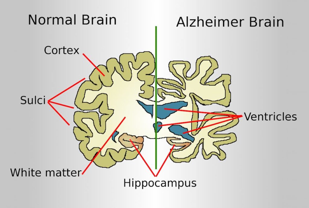 Alzheimer’s disease